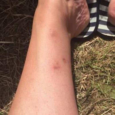 Vasculitis After ICE 1