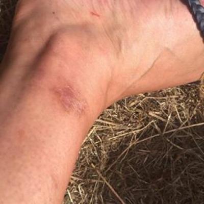 Vasculitis After ICE 2