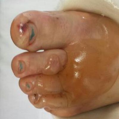 Chemical Burned Foot