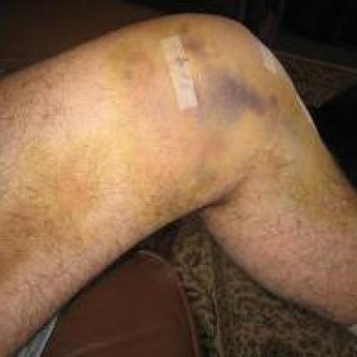 Bruised knee