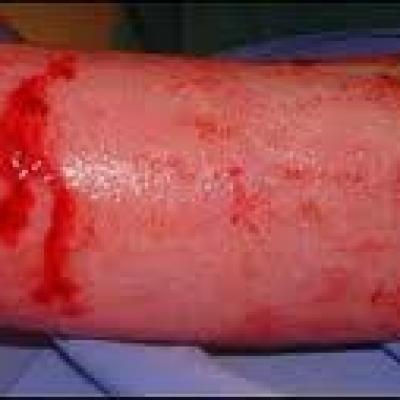 Red raw wound repair